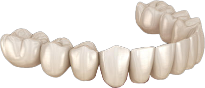 풀아치 임플란트2